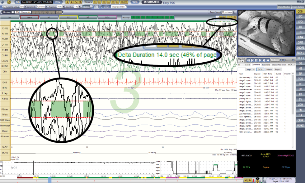 Easy Iii Psg Software For Psg And Hsat Sleep Studies